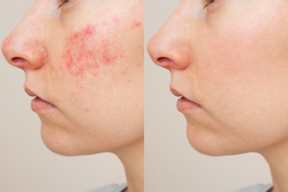Does Alcohol Cause a Vein Condition?