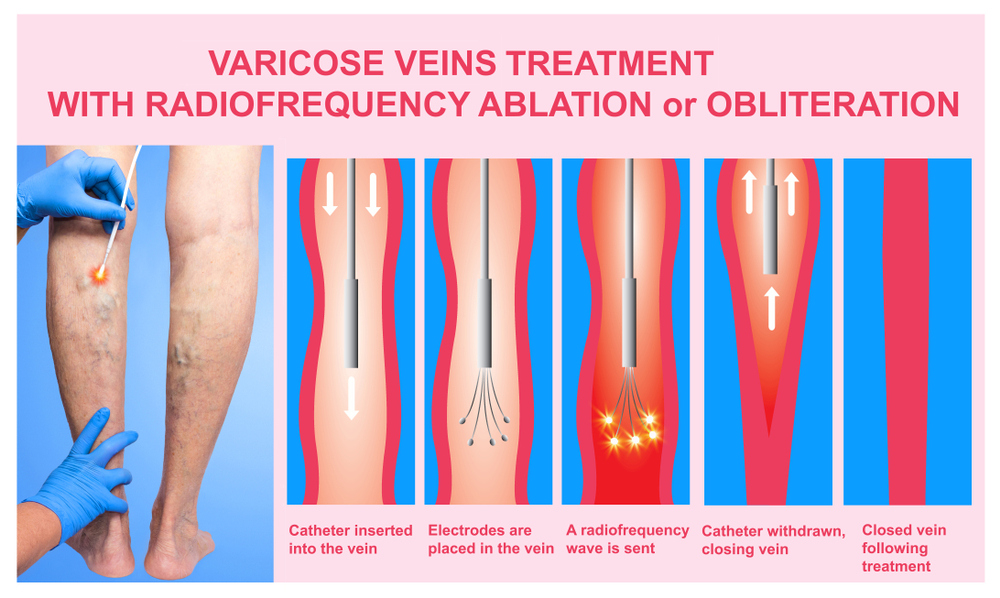 Endovenous ablation EVA
