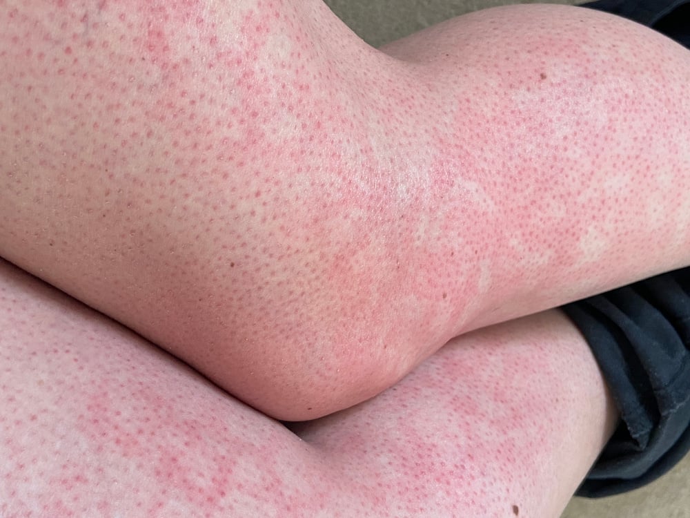 Mottled